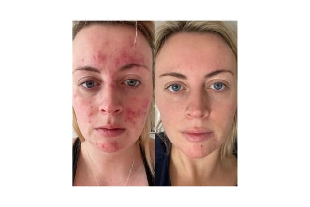 Abigail's results with 47 Skin