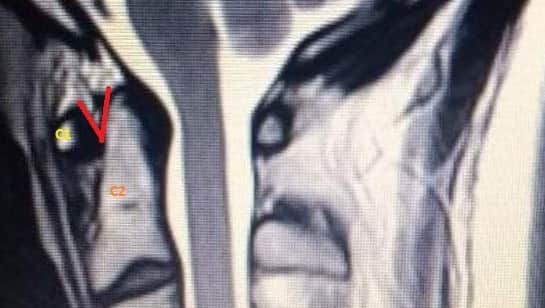 Another X-Ray shows the problem with his skull