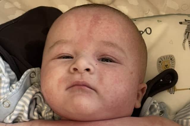 Harry has severe eczema and it affects his whole body