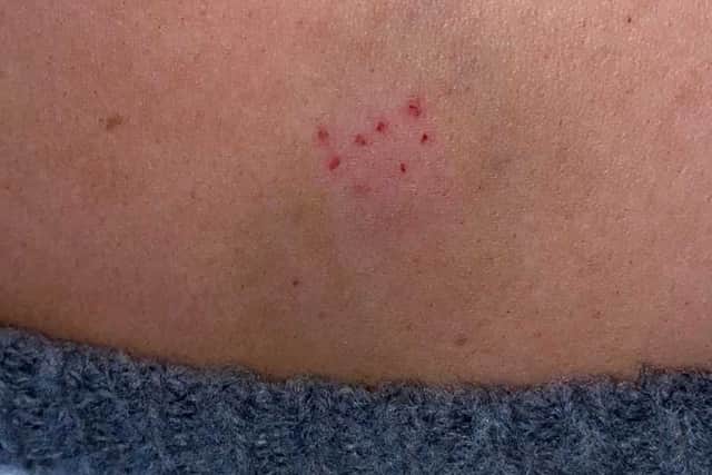 Laura Jones had a mark on her shoulder resembling a needle spiking wound