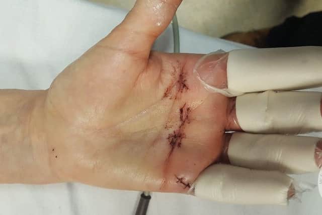 Both the victims sustained serious hand injuries