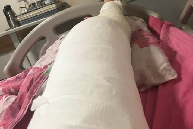 His leg in plaster