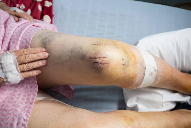 One of Marie's injuries