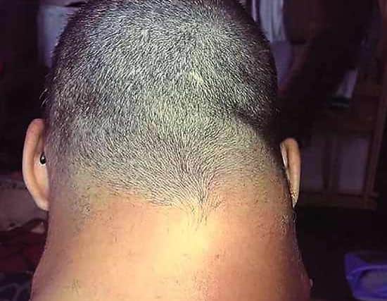 The lump on Simon's neck