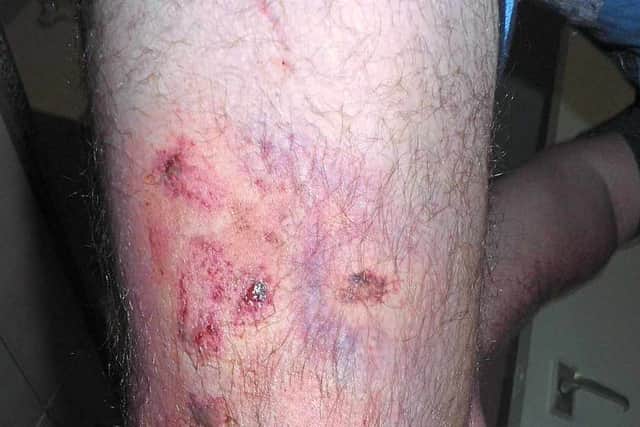 Mr Deeley-Brewer's injured leg