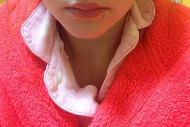 Another image of Katie's injuries.