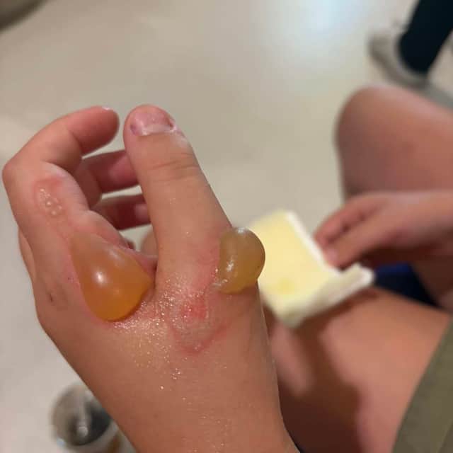 The blisters caused by the toy