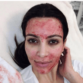 Kim Kardashian getting a 'vampire facial'