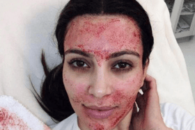 Kim Kardashian getting a 'vampire facial'