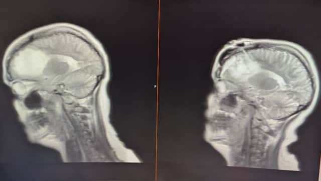 Laura Owen's pre and post-operation scans, side by side