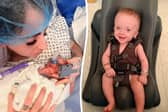 Baby Samson was diagnosed with spina bifida myelomeningocele