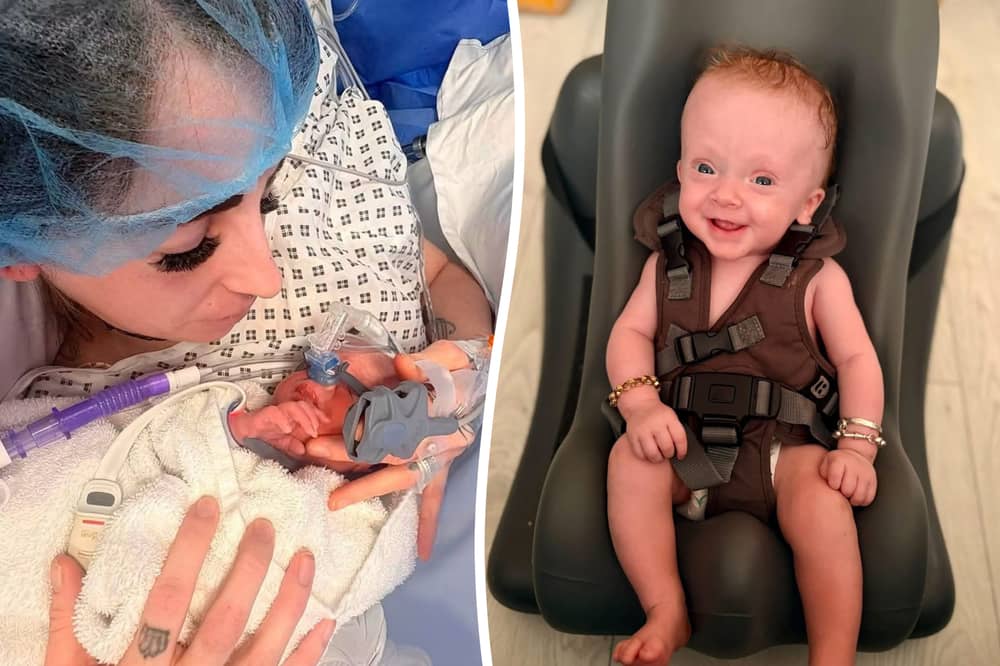 Baby Samson was diagnosed with spina bifida myelomeningocele