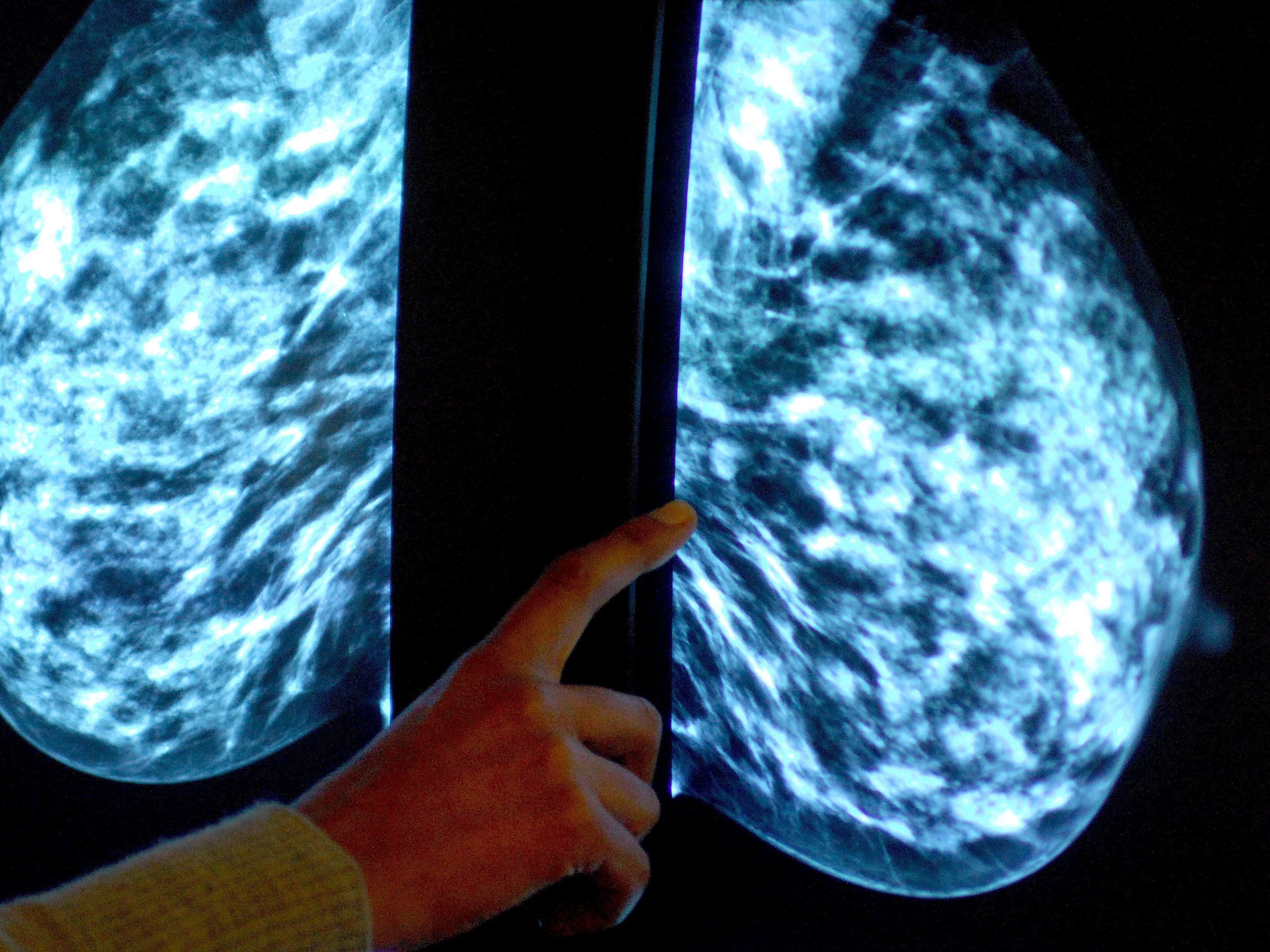 Health watchdog backs wider use of breast cancer tumour profiling tests