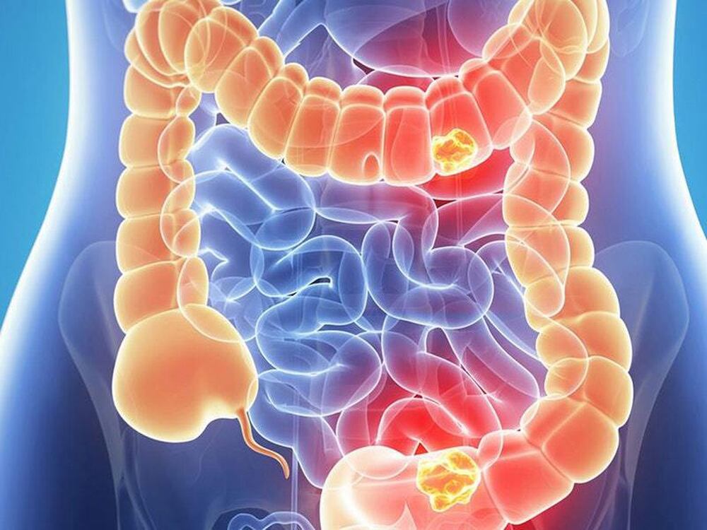 What Is Bowel Cancer And How Common Is It Express And Star