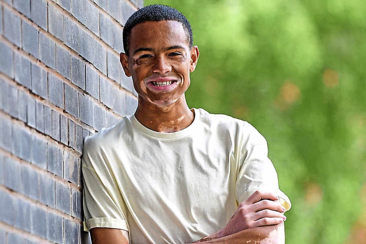 Nile Goodlad, aged 20, from Walsall, has vitiligo a condition that means th...